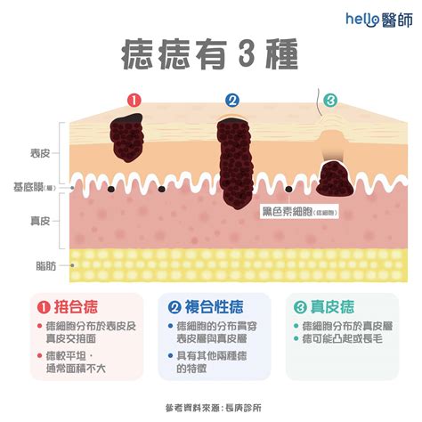 痣 形成原因|痣形成的原因？痣長毛、痣變多變大是痣病變？5招判。